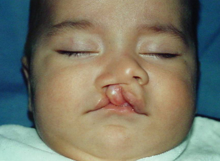 Paciente de tres meses con fisura labial derecha completa.