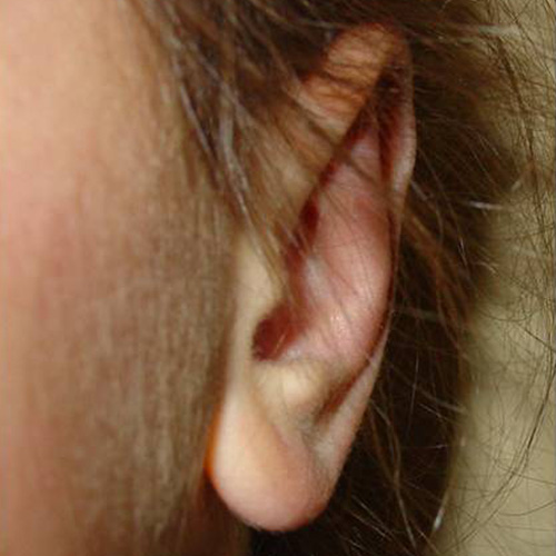 La oreja izquierda tres meses despues de la operacion.
