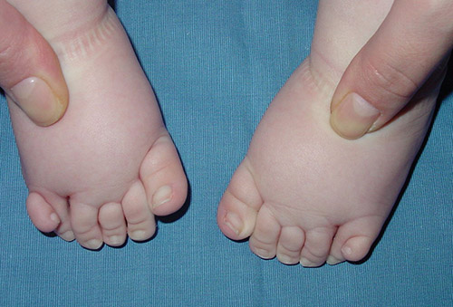 Polidactilia de ambos pies antes de la cirugía.