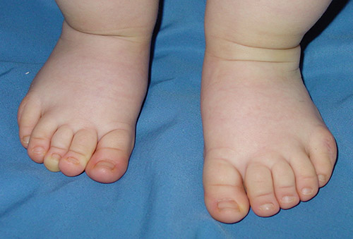 Polidactilia de ambos pies después de la cirugía.
