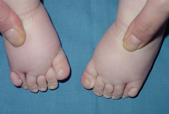 Polidactilia de ambos pies
